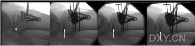 图 2 ：侧位片，显示球囊成形过程。注意观察塌陷平台的抬高过程（箭头）。